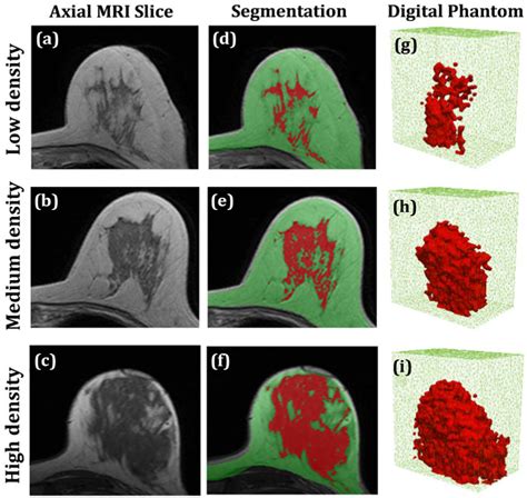 Figure 2 From Breast Density Quantification Using Structured Light