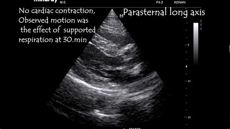 Abdominal Aorta Ultrasound