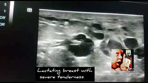 Breast Abcess With Duct Ectasia Ultrasound By Dr Haissam Aref Dms Msc Md Ultrasound Youtube