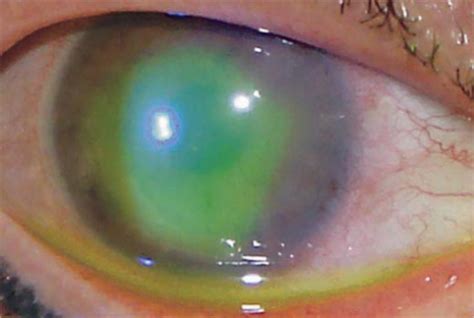 Figure 1ultraviolet A Light And Riboflavin Therapy For Acanthamoeba Keratitis A Case Report