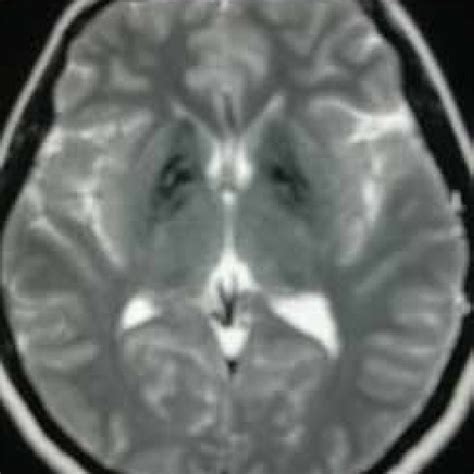 Gradient Echo T2 Sequence Mri This Mr Sequence Is Usually Included