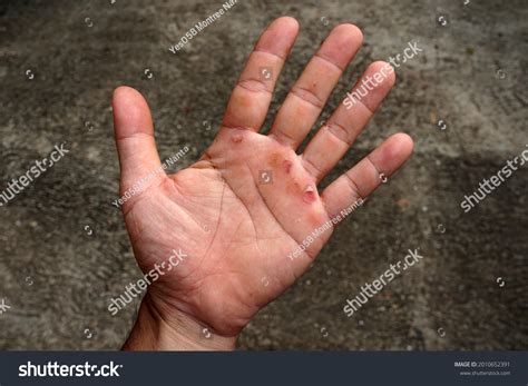 Blister On Hand Overwork Wound On Stock Photo 2010652391 Shutterstock