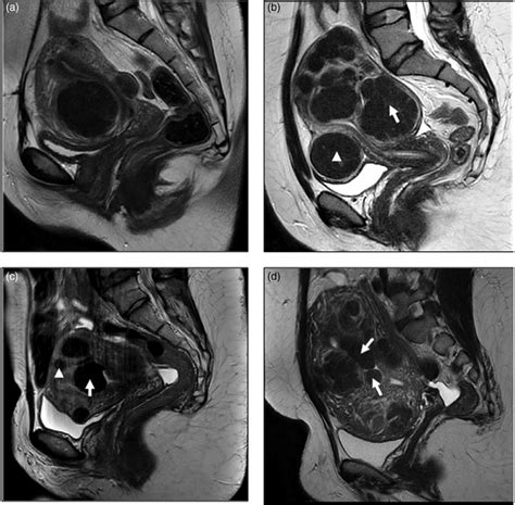 Magnetic Resonance Imaging Of Fibroids Midline Sagittal T2 Weighted