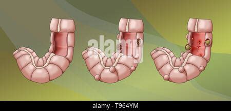 Abbildung Vergleich Von Einem Doppelpunkt Mit Diverticulosis