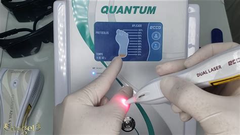 O MELHOR LASER DO MUNDO PARA PODOLOGIA Ecco Fibras Equipamentos