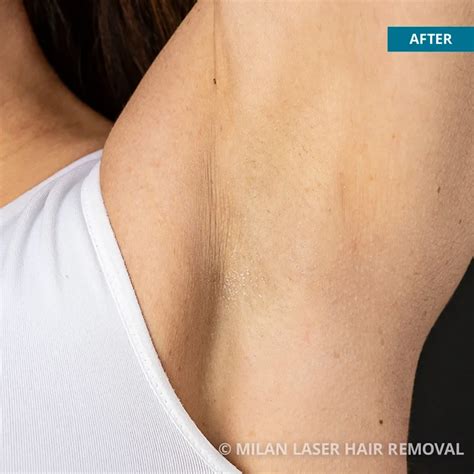 Underarm Before After Photos Of Laser Hair Removal Milan Laser In