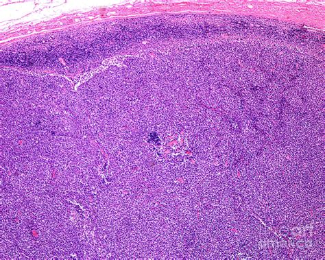 Reticulosarcoma Of The Lymph Node 1 By Jose Calvo Science Photo Library