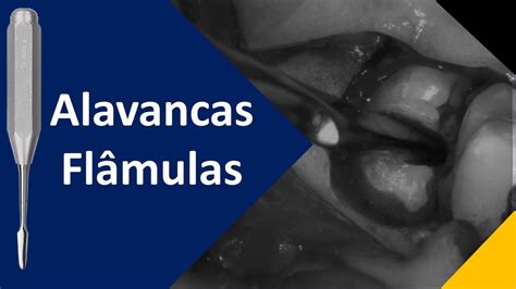 Alavancas Flâmulas Odontologia Dra Bianca Rosa YouTube