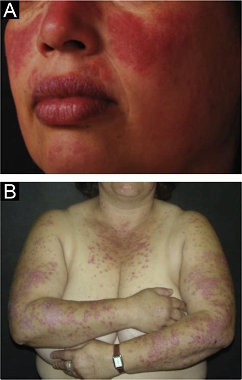 Chronic Cutaneous Lupus Erythematosus Hot Sex Picture