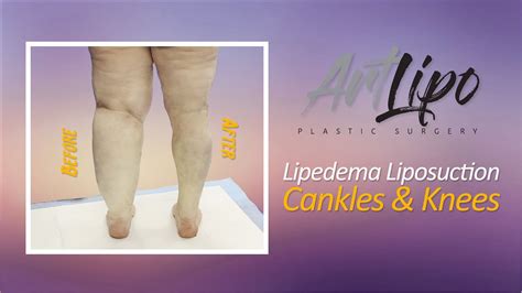 Lipedema Leg Liposuction Results Lipo 360° Cankles And Knees Expert