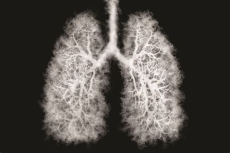 New Lung Cancer Screening Recommendations Imar Concierge Medicine