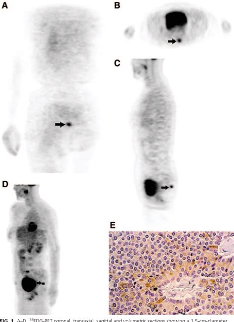 Figure 1 From Corticotrophin Dependent Cushing Syndrome Due To