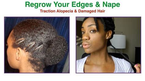 How To Regrow Protect Thin Damaged Edges Nape Traction Alopecia