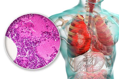 What Is Lobar Pneumonia