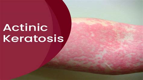 Actinic Keratosis: Causes, Symptoms, Risk Factors, Treatments And ...