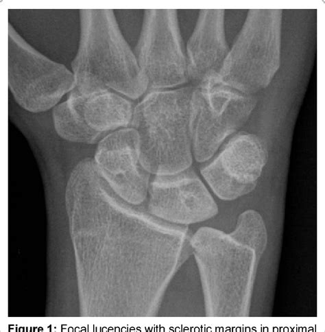 Figure 1 From Multifocal Avascular Necrosis Of The Lunate And