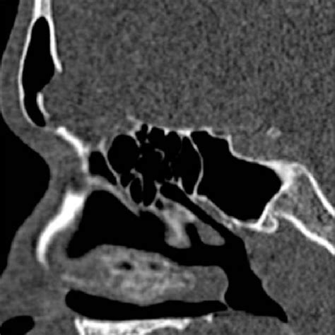 A B Frontal And Ethmoidal Sinus Herniation Of The Brain Tissue