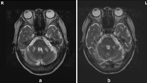 Mri Of The Patient An Axial T2 Weghted Image Revealed High Signal Download Scientific Diagram