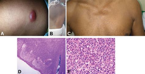 (A) Reddish painless nodules over the trunk; (B, C) Complete ...