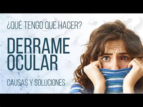 Descubre Las Causas Y Tratamientos Para Los Derrames En Los Ojos Por