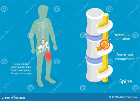 Sciatica Vs Piriformis Medical Muscle Conditions Comparison Outline