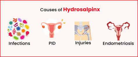 Hydrosalpinx: Causes, Symptoms, Diagnosis & Treatment