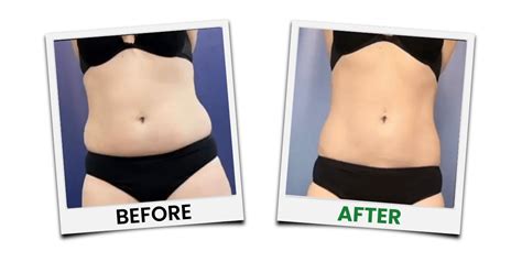 Cold Fat Removal Treatment Emerald Laser By Erchnoia