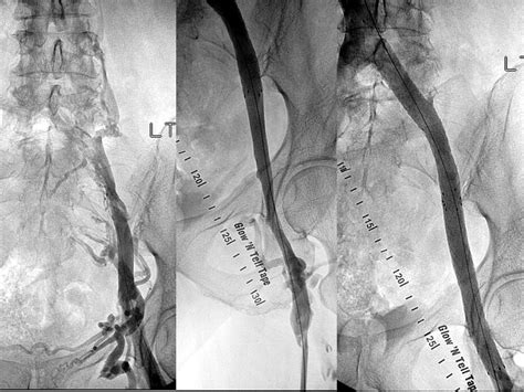 Venous Stenting Across The Inguinal Ligament Journal Of Vascular Surgery