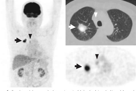 Figure 3 From A Case Of Pulmonary Lymphoepithelioma Like Carcinoma