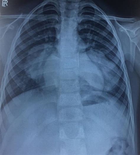 Chest X Ray Posteroanterior View Showing Bilateral Hydatid Cysts