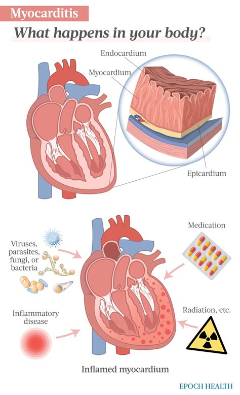 Guía Esencial De La Miocarditis Síntomas Causas Tratamientos Y Otros