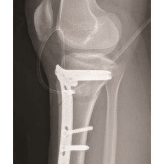 Lateral Radiographs Of Open Wedge High Tibial Osteotomy With Distal