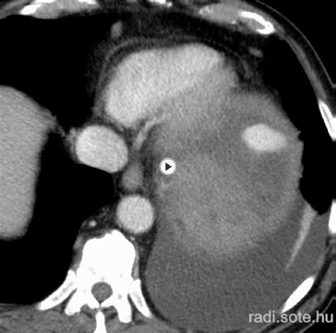 Figure 1 From Spontaneous Pathologic Splenic Rupture A Rare And Life