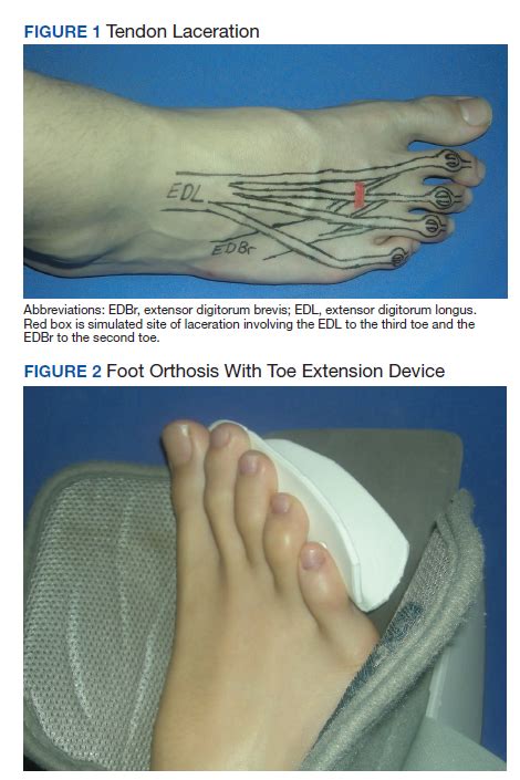 Application of Hand Therapy Extensor Tendon Protocol to Toe Extensor ...