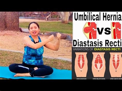 Abdominal Bulging Diastasis Recti Or Hernia Beginner Core Program To