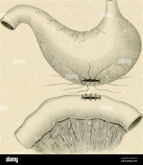 Operative Surgery Fig 976 The Operation Of Gastro Enterostomy