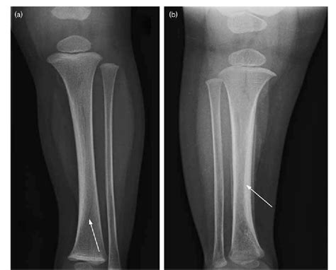 Figure 1 From Management Of The Toddlers Fracture With And Without