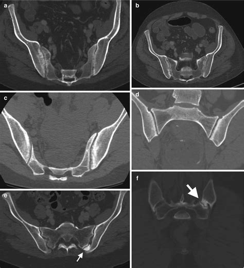 Spondyloarthropathy | Radiology Key