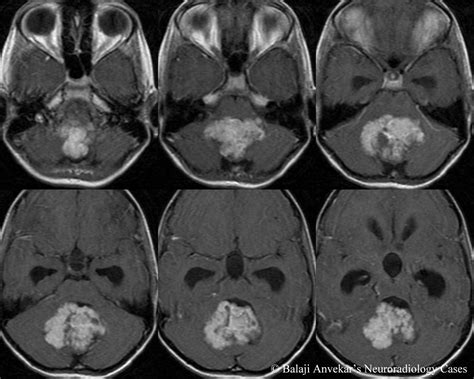 Dr Balaji Anvekar Frcr Fourth Ventricular Mass Mri