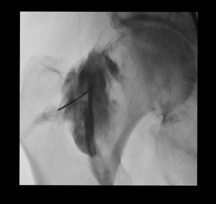 Hip Arthrogram Injection