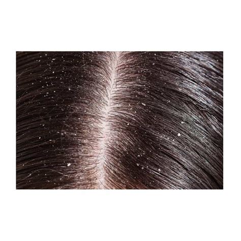 Dandruff Treatment Symptoms Risk Factors With Success Story