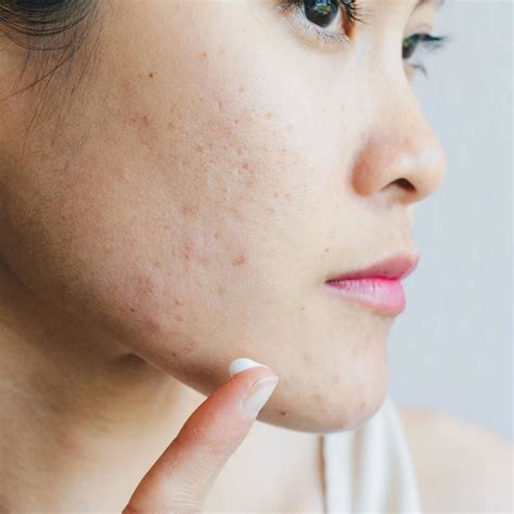 How To Get Rid Of Chin Pimples Effectively And Fast Skinmart