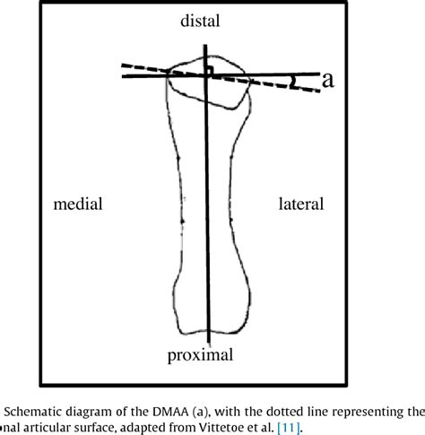 Distal Metatarsal Articular Angle