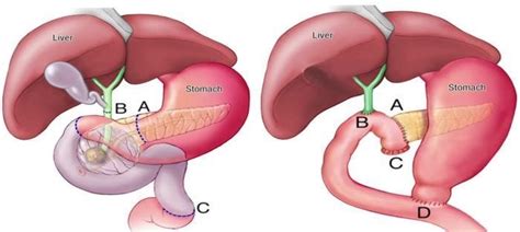 The Anatomy of a Whipple Procedure | by Let’s Win! Pancreatic Cancer | Medium