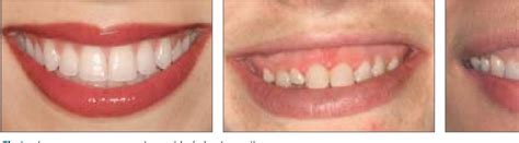 Figure 1 From Excessive Gingival Display Etiology Diagnosis And