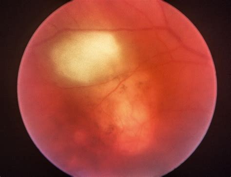 Ocular Toxoplasmosis Clinical Tree