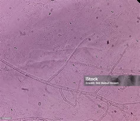 Microscopic Fungi Malassezia Furfur Showing Yeast Cells And Hyphae Dermatophytes Nail Scraping