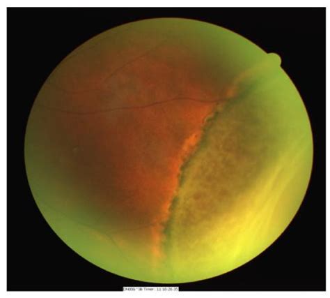 Fundus photograph of the same eye demonstrating peripheral retinal ...