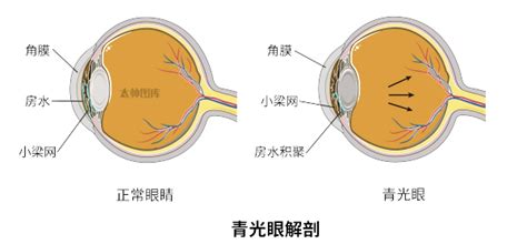 青光眼解剖（标注版） 医学插画