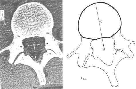 Figure 1 From In Vivo Axial Rotation At The Thoracolumbar Junction An